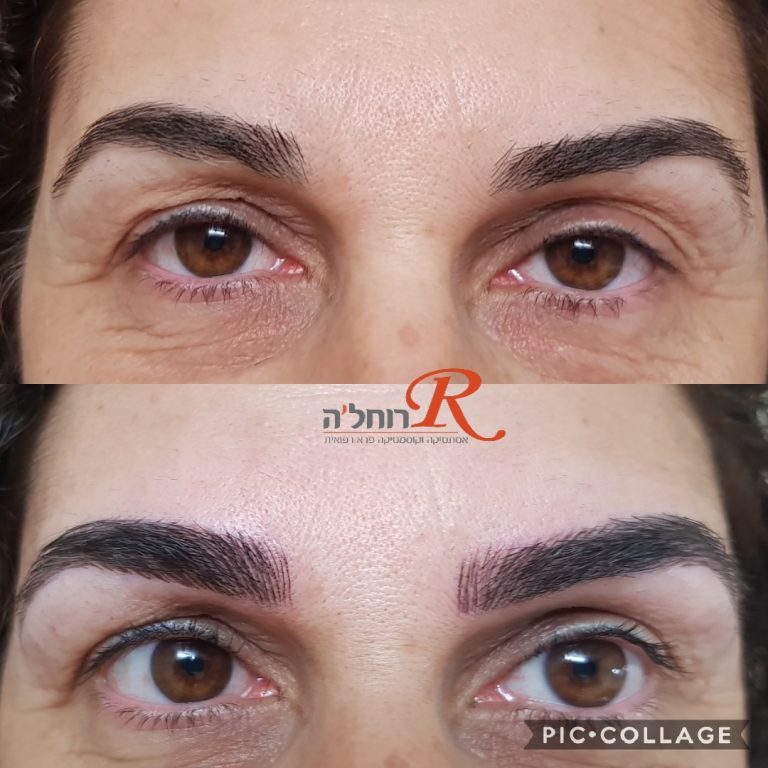 שיטת השערה מיקרובליידינג