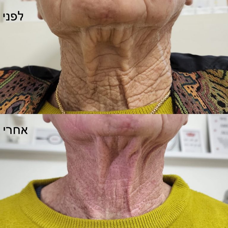 הרמת עפעפיים ללא ניתוח